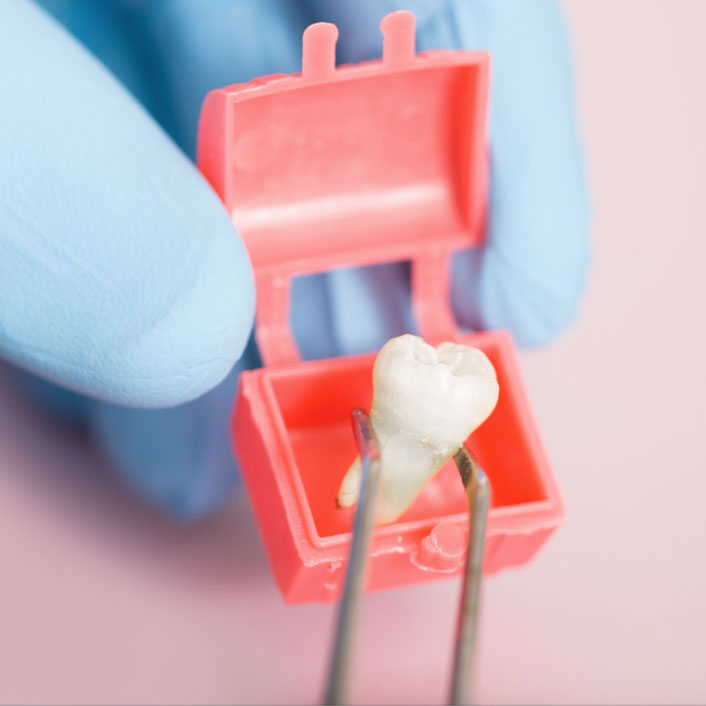 Tooth Extractions - Dental Services