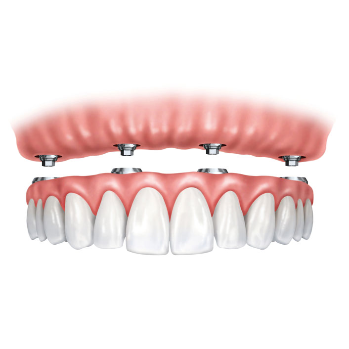 Dental Implant Dentures - Dental Services