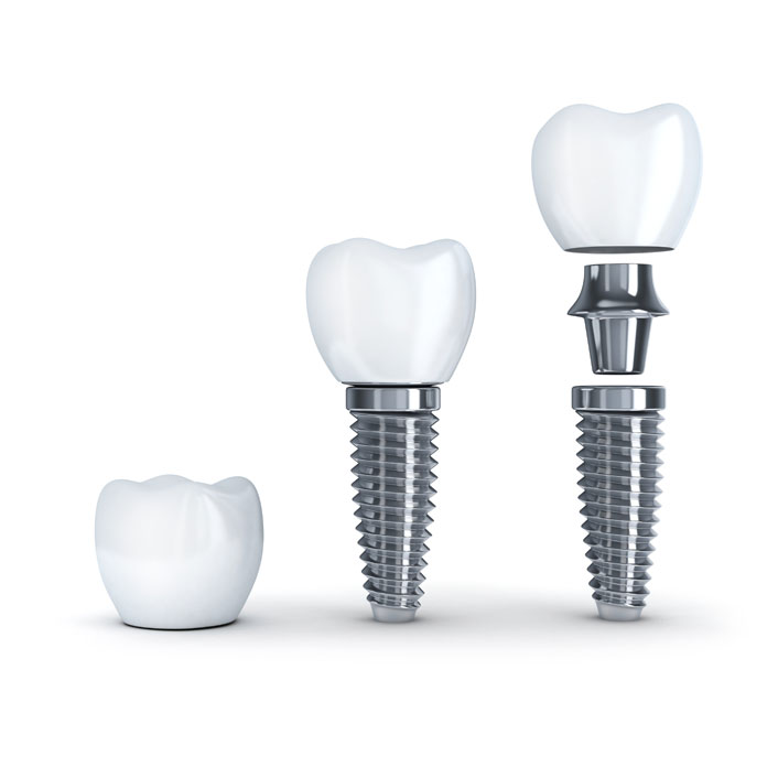 Implant Restoration