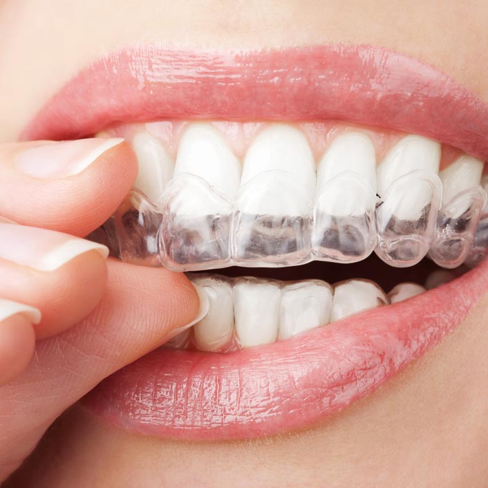 Invisalign®